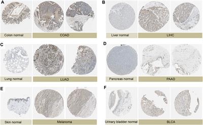 Systematic pan-cancer analysis of the potential tumor diagnosis and prognosis biomarker P4HA3